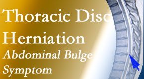Most Chiropractic Clinic cares for thoracic disc herniation that for some patients prompts abdominal pain.