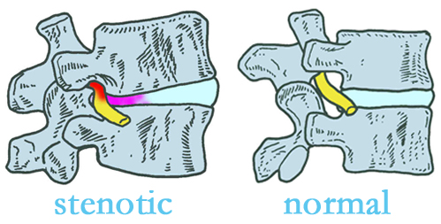 Murfreesboro stenotic and normal spinal discs