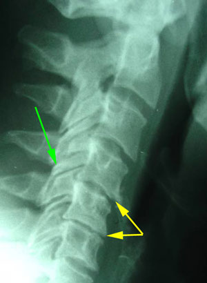 disc degeneration treated at Most Chiropractic Clinic