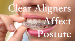 Clear aligners influence posture which Murfreesboro chiropractic helps.