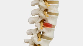 Murfreesboro chiropractic conservative care helps even giant disc herniations go away