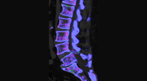 Most Chiropractic Clinic is aware that inflammatory spinal gout is a differential diagnosis to consider for patients who present with back pain and other spine related symptoms.