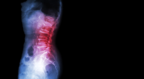 Murfreesboro Chiropractic Care of Spondylolisthesis 