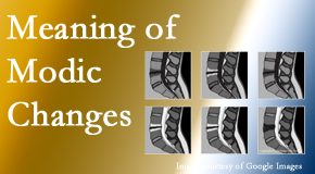 Most Chiropractic Clinic sees many back pain and neck pain patients who bring their MRIs with them to the office. Modic changes are often seen. 
