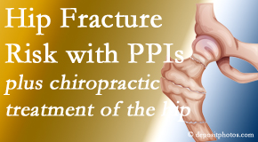 Most Chiropractic Clinic shares new research describing higher risk of hip fracture with proton pump inhibitor use. 