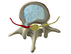 extrusion of disc