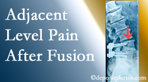 Most Chiropractic Clinic offers relieving care non-surgically to back pain patients experiencing adjacent level pain after spinal fusion surgery.
