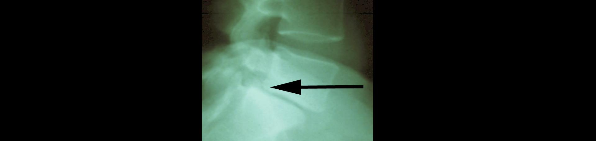 Murfreesboro spondylolisthesis 