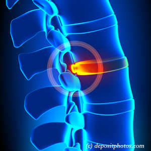 image of lumbar Murfreesboro disc herniation