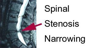 xray image of spinal stenosis narrowing